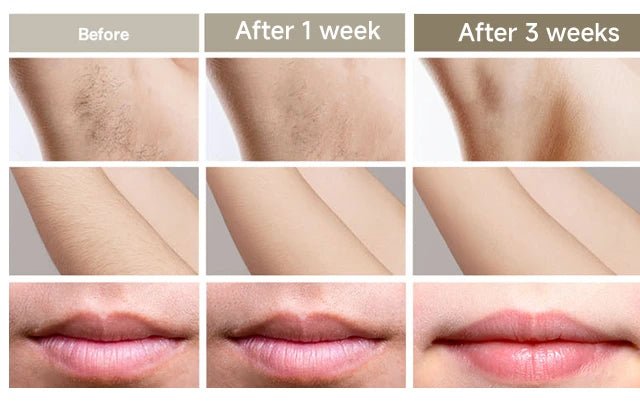 SilkPulse™ – IPL Permanent Laser Hair Removal Device with Ice Cooling - Katchy Vibez