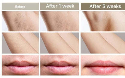 SilkPulse™ – IPL Permanent Laser Hair Removal Device with Ice Cooling - Katchy Vibez